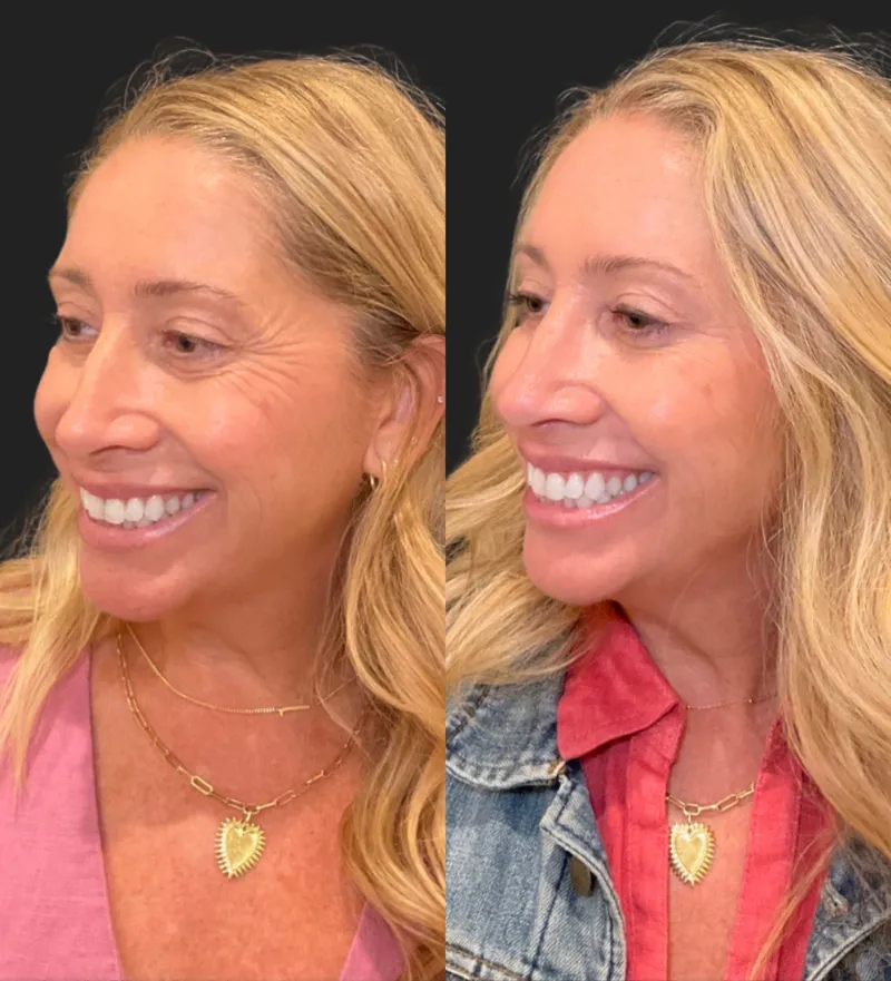 Botox before and after — Crow's feet before and after