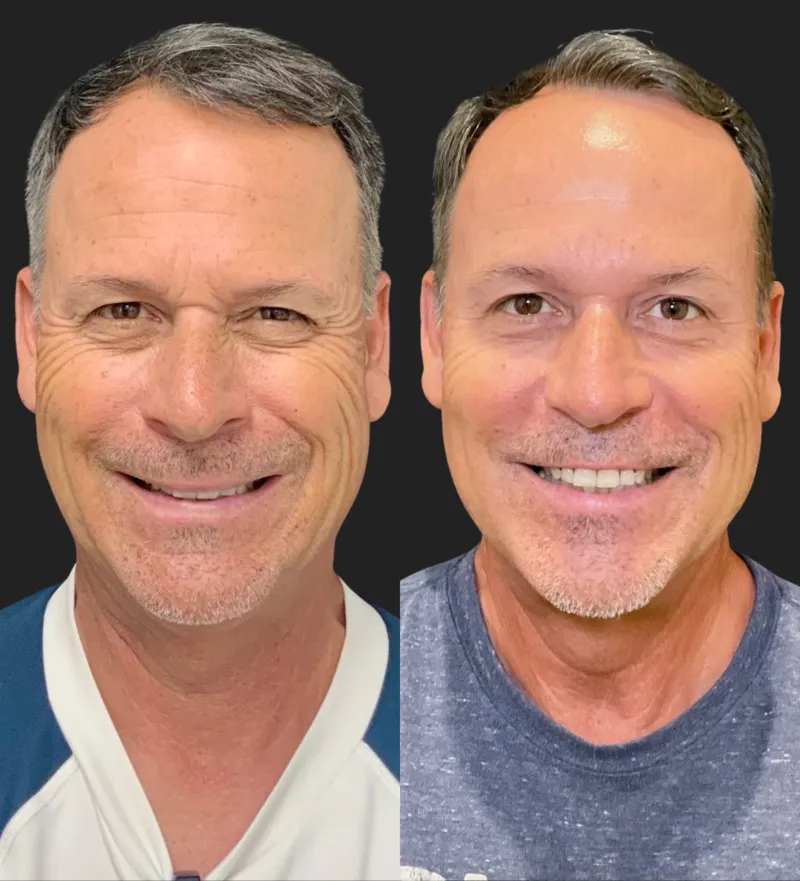 Botox before and after — Forehead and crow's feet before and after