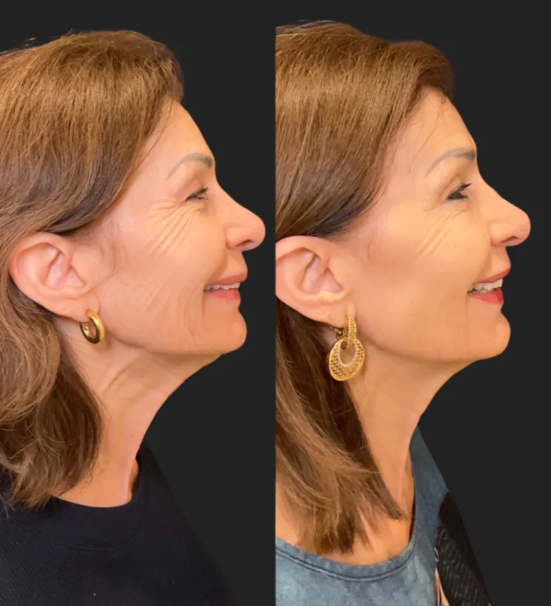 Botox before and after — Crow's feet and jawline before and after